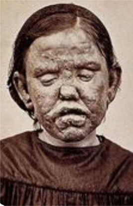 1867 A form of leprosy then known as elephantiasis