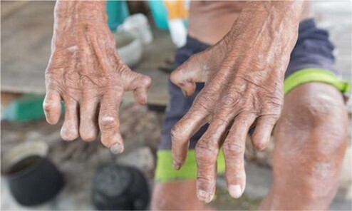 Disfigured hands as a result of leprosy