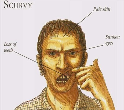 Scurvy
