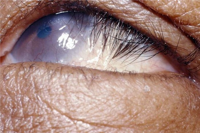 Trachoma