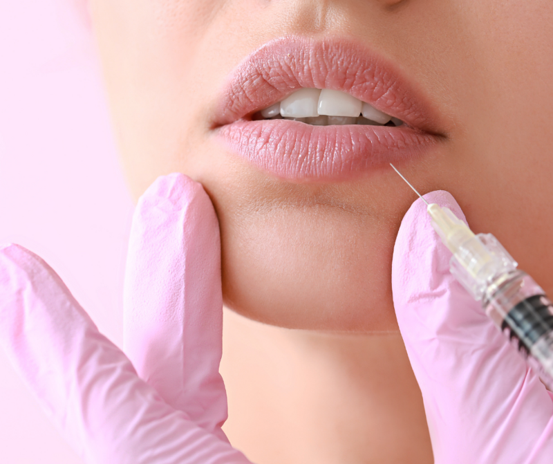 Dermal lip filler
