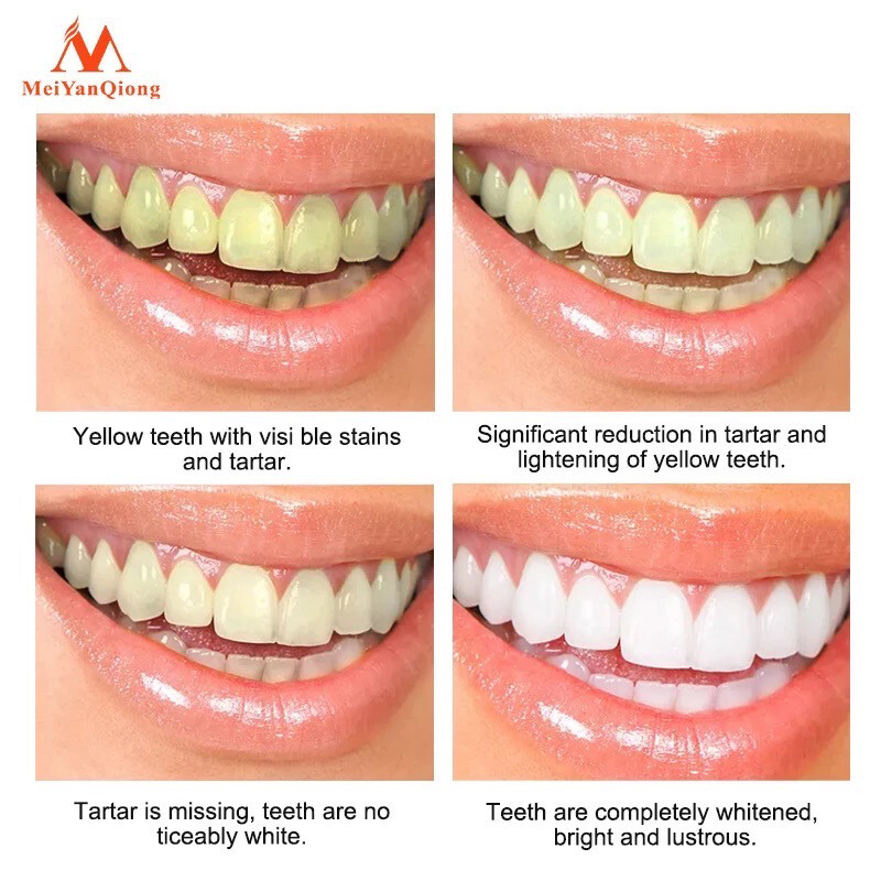 Teeth Whitening Treatment