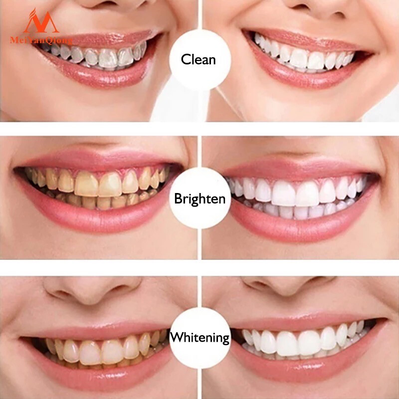 Teeth Whitening Treatment