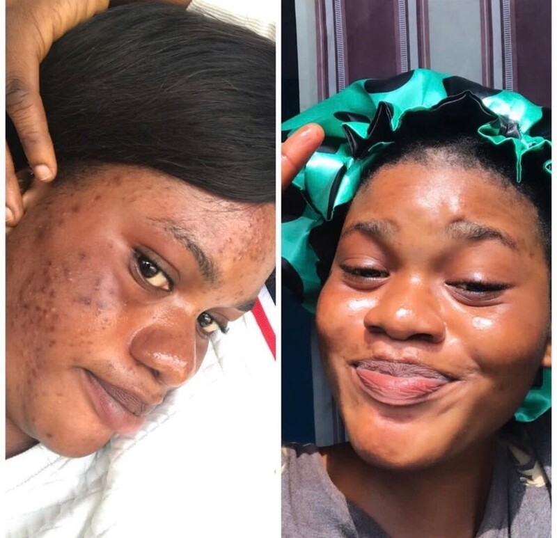 Acne natural soap