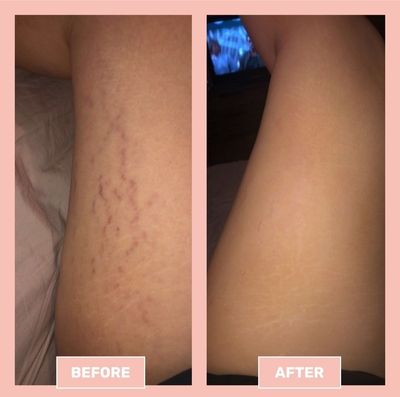 Stretch Marks Removal Cream