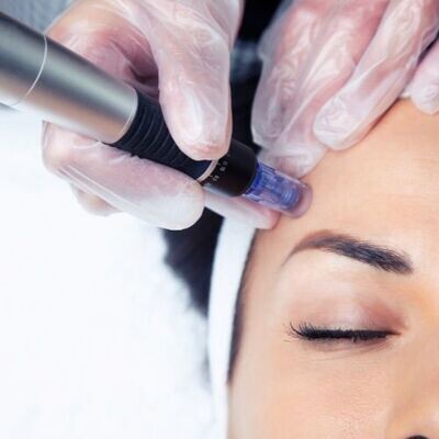 Microneedling