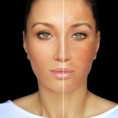 Hyperpigmentation