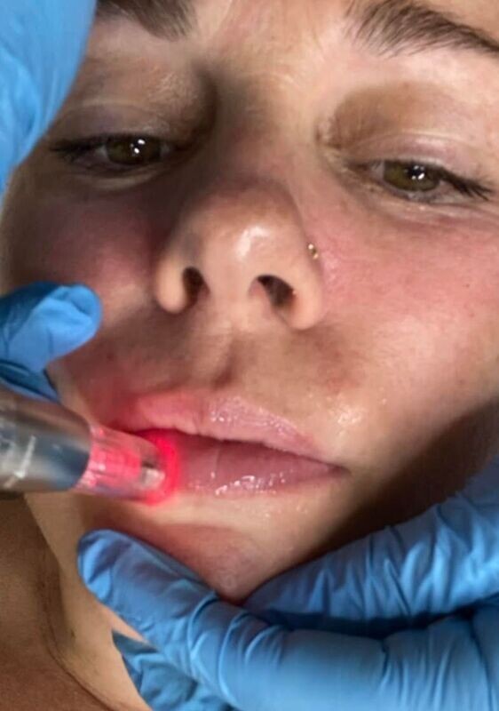 Dermapen 4 en 1 + lips glow