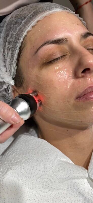 Radiofrecuencia facial