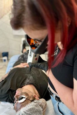 CARBON GLOW LASER PEEL