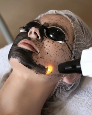 CARBON GLOW LASER PEEL
