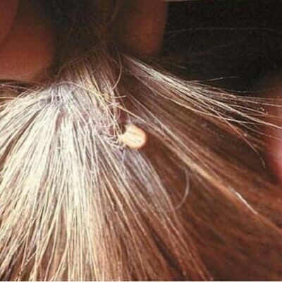 Lyme Disease