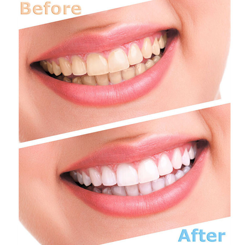 Teeth Whitening Gel Peroxide Dental Bleach Gel