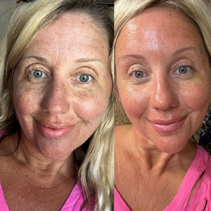 Facial Peel
