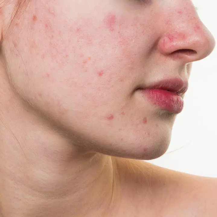 Anti  Acne Azelaic Acid serum