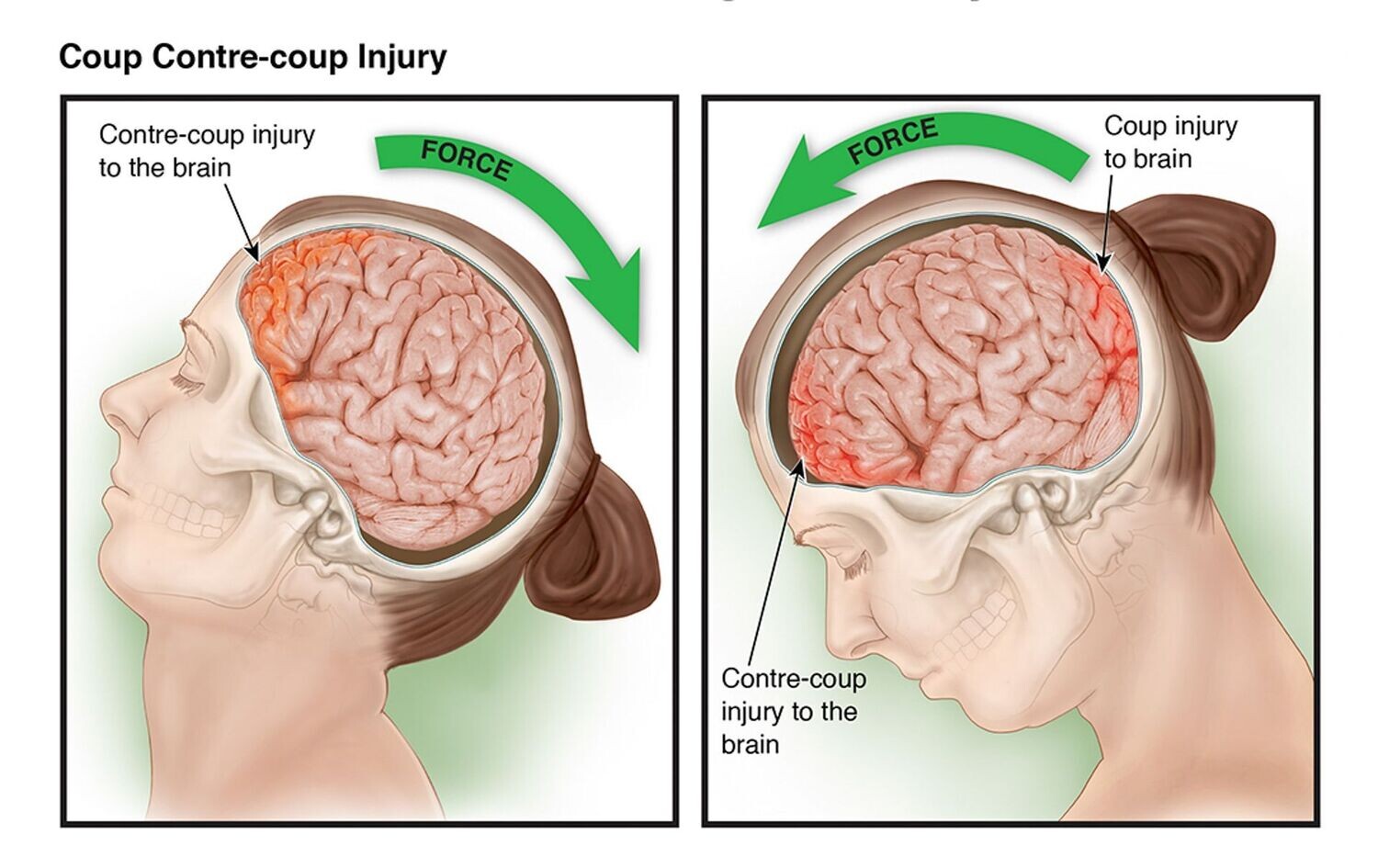 ​Coup Countre-coup Injury