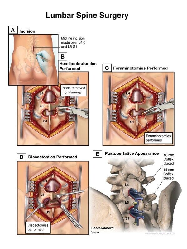 Lumbar Spine Surgery