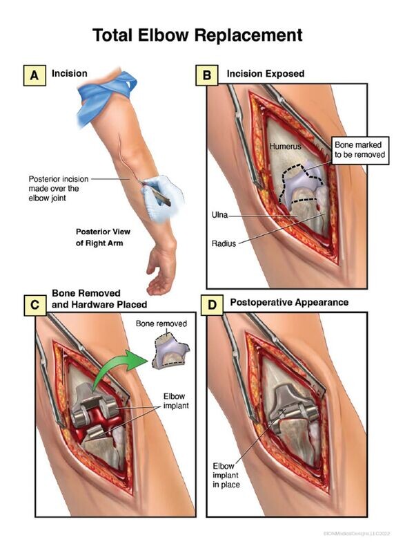 Total Elbow Replacement