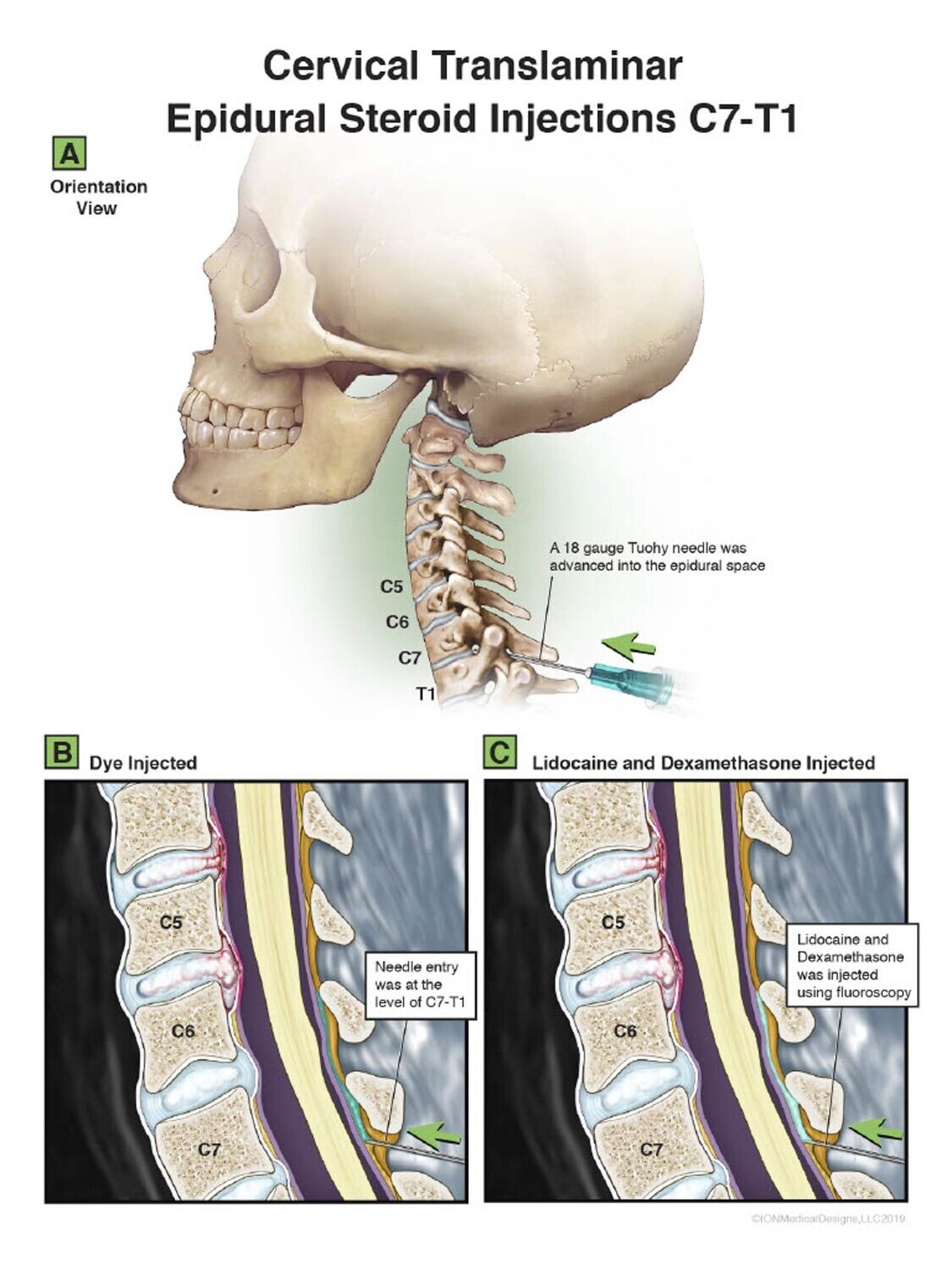 ​Cervical Translaminar Epidural Steroid Injections C7-T1