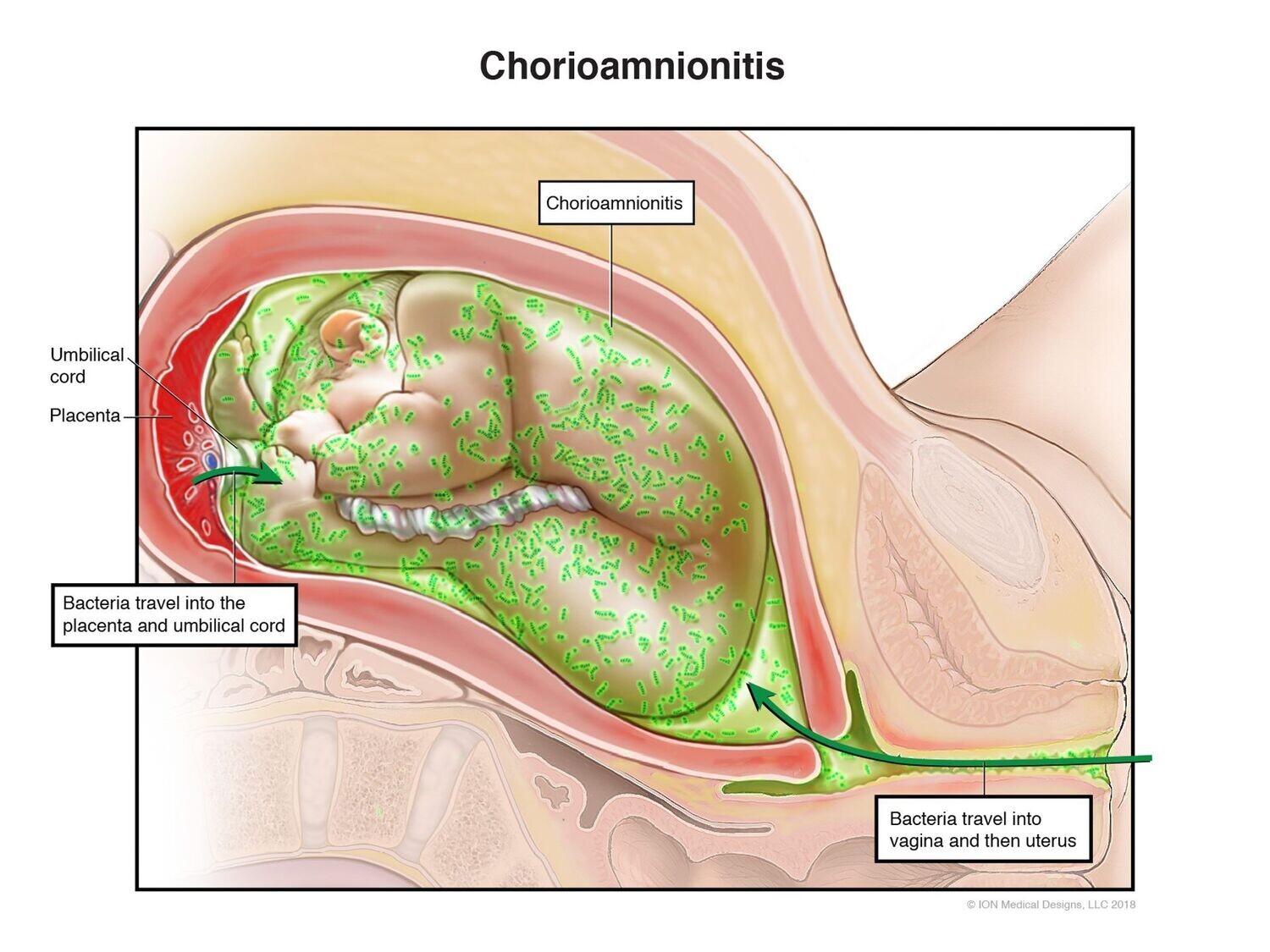 ​Chorioamnionitis Infection