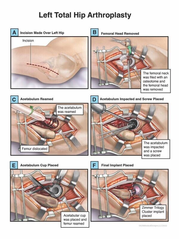 ​Left Total Hip Arthroplasty