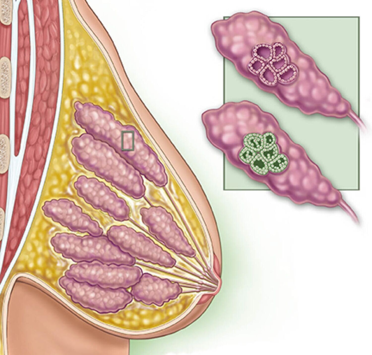 Lobular Carcinoma