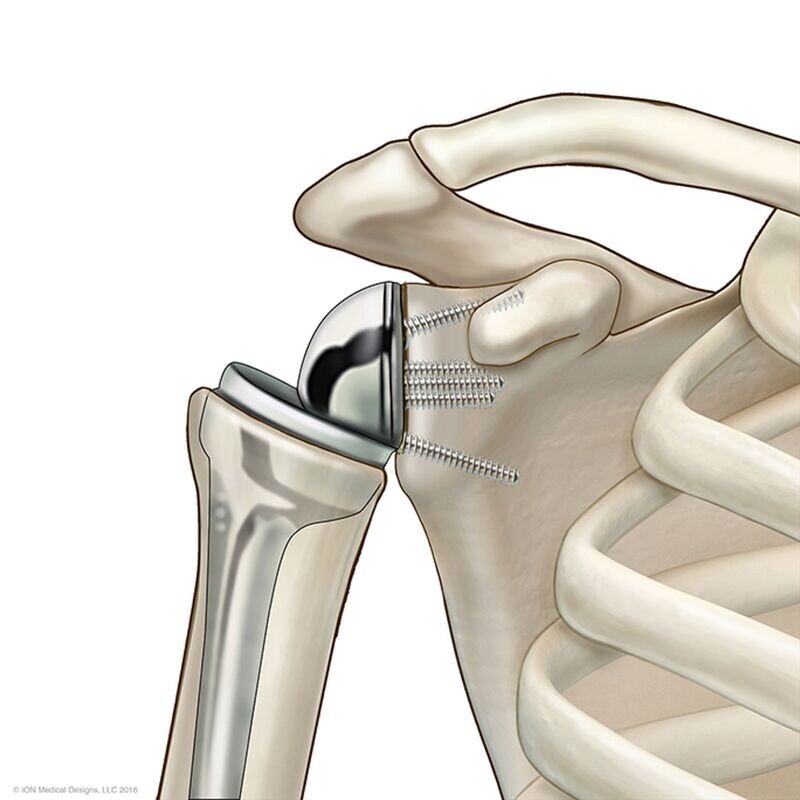 Total Reverse Shoulder Implant