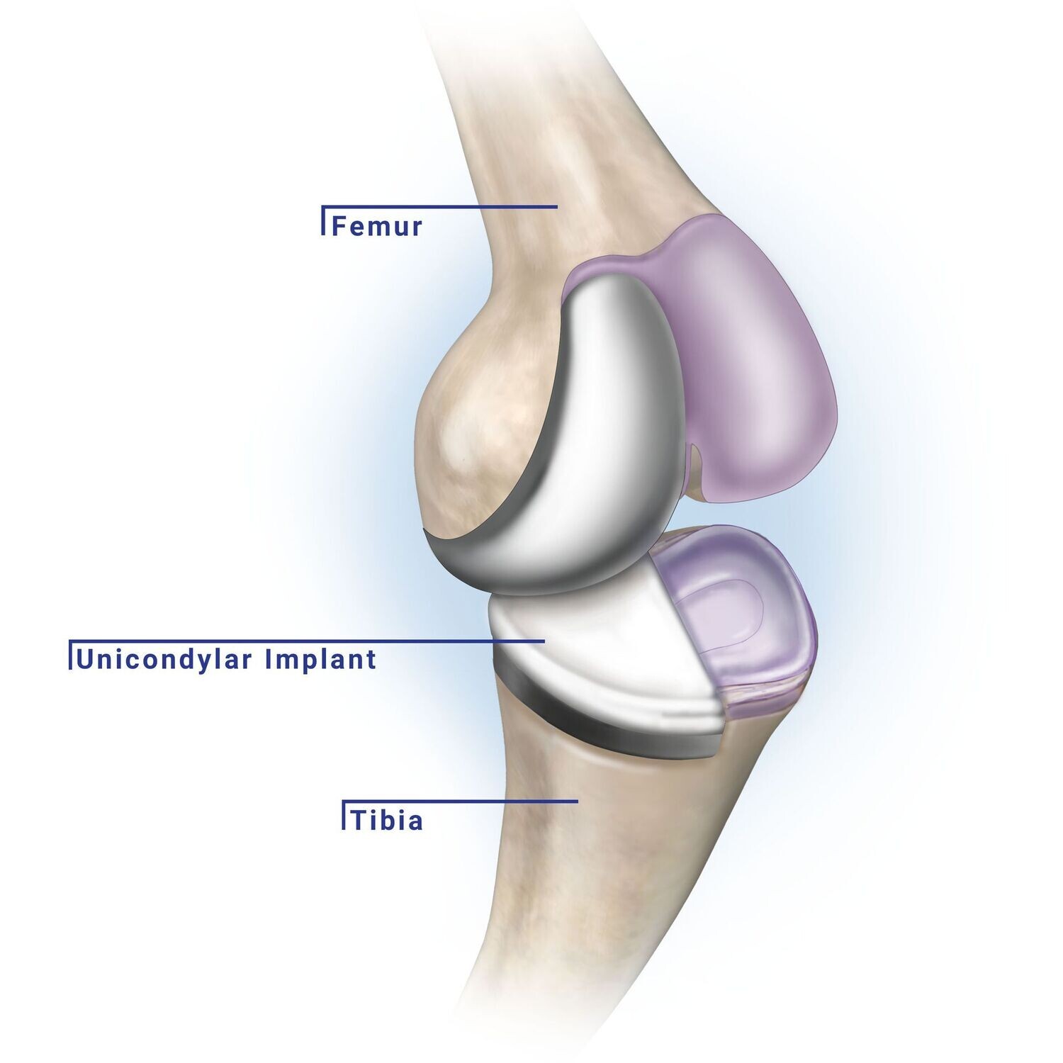 Unicondylar Implant