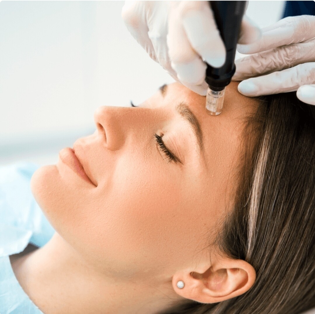 Microneedling with PRP/PRF