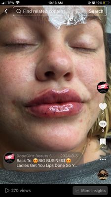 Syringe Lip Filler Training✨💉