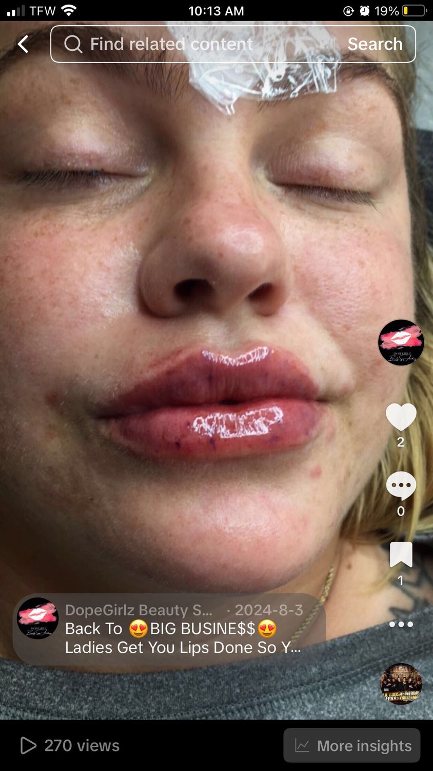 Syringe Lip Filler Training✨💉