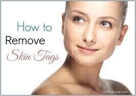 Nuvei Skin Tag Remover Canada