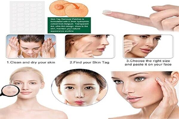 Nuvei Skin Tag Remover Canada