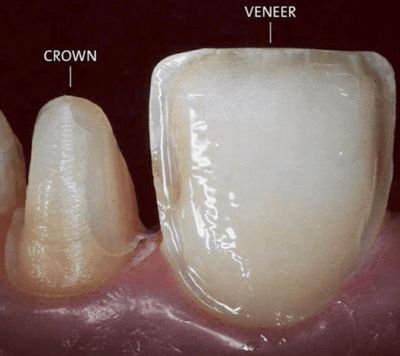 CROWN &amp; VENEER PREPARATION BURS