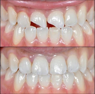 ENAMEL COMPOSITES - SHOFU 2.5gm