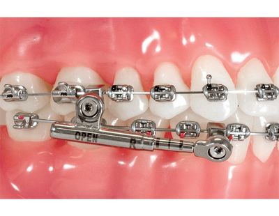POWER SCOPE CLASS II CORRECTOR ( 5pcs / Kit ) - AMERICAN ORTHODONTICS