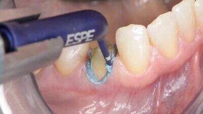 RETRACTION PASTE ( 0.5gm x 20 Tips ) - SUPERTRACT