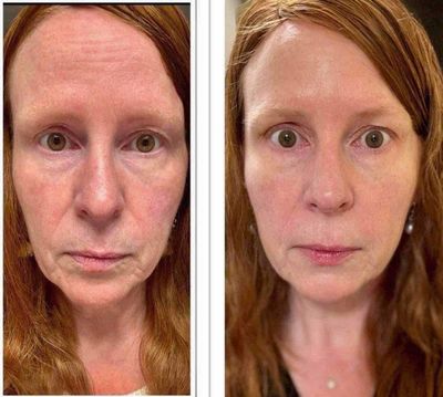 Retinol Peptide Complex