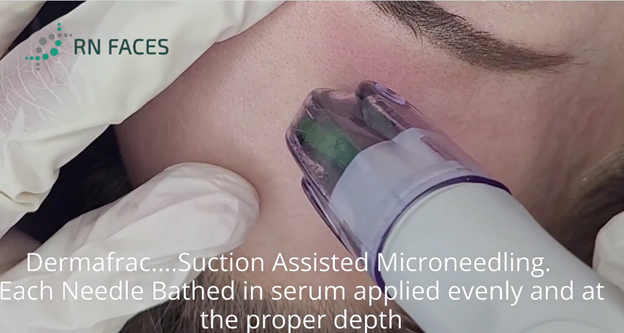 Dermafrac Micro Channeling-Microdermabrasion