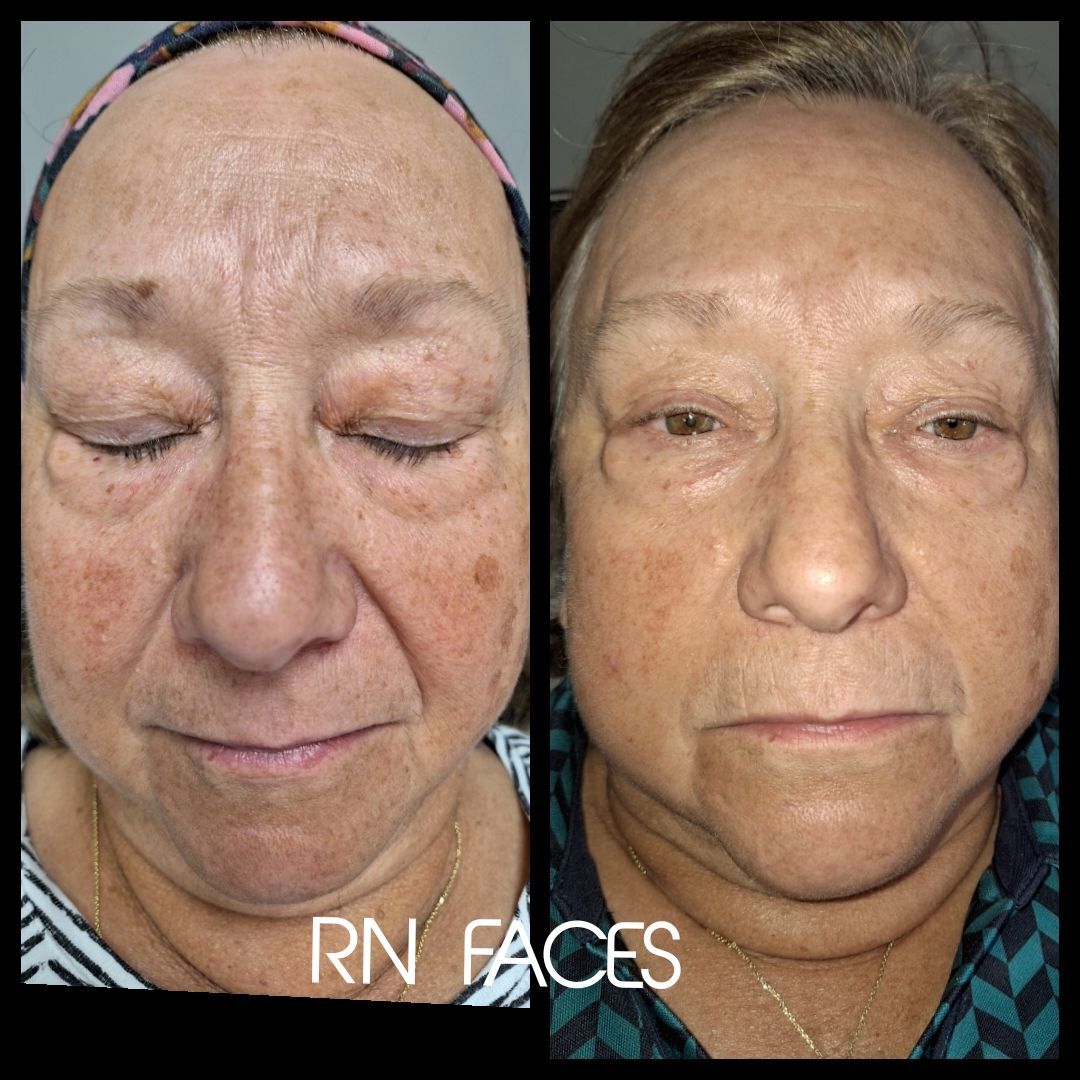 Online DermaFrac Training