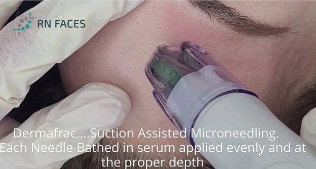 Dermafrac Micro Channeling-Microdermabrasion (wet or dry)* Dermafrac Micro Channeling-Microdermabrasion (wet or dry)*