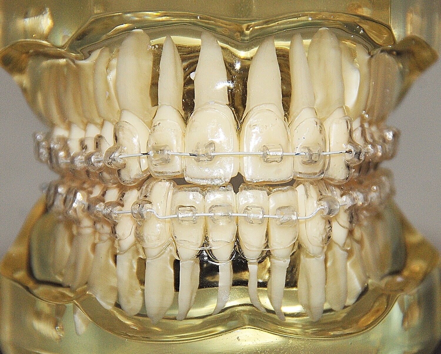 Powerful HYBRID ALIGNERS Pre Invisalign
