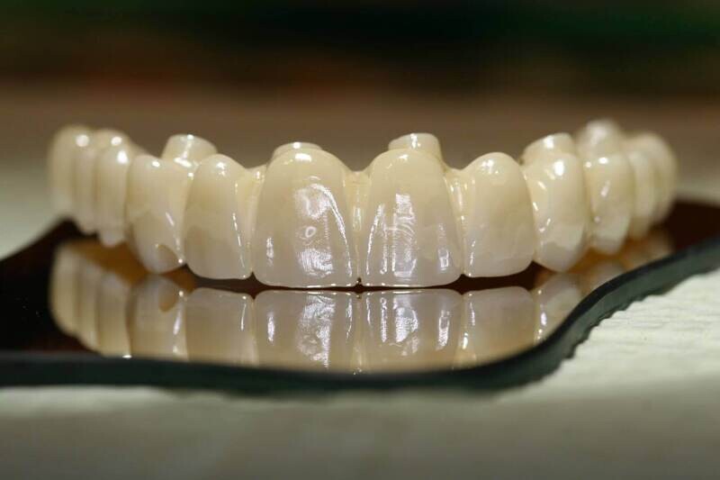 Full Arch Zirconia Bridge AllonX Zirconia Abutments Fixed TDILab.app