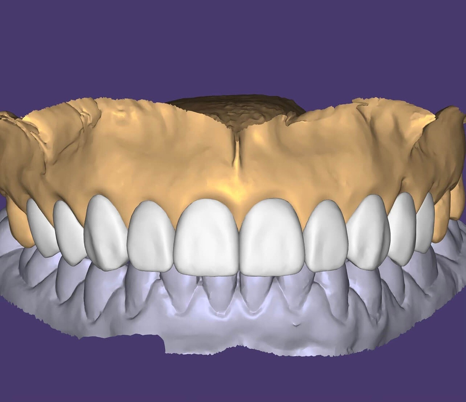Full Arch Wax Up