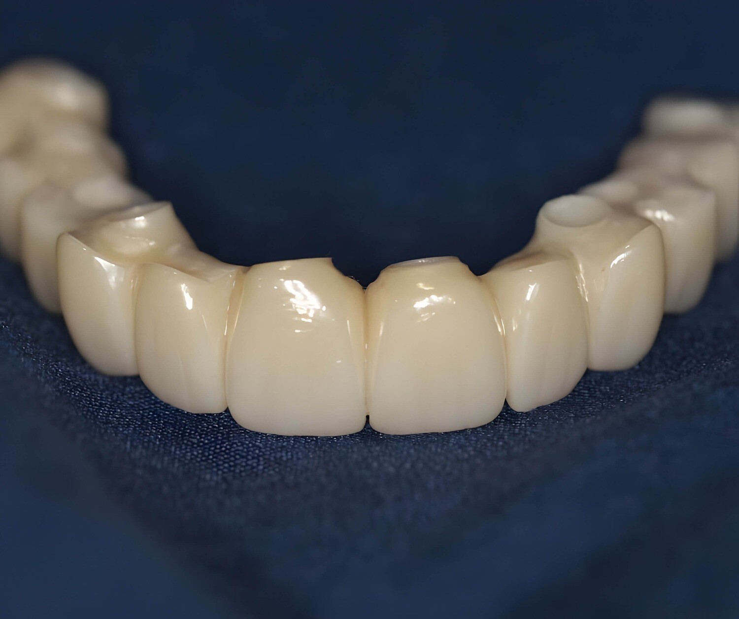 Zirconia Bridge on Titanium Abutments