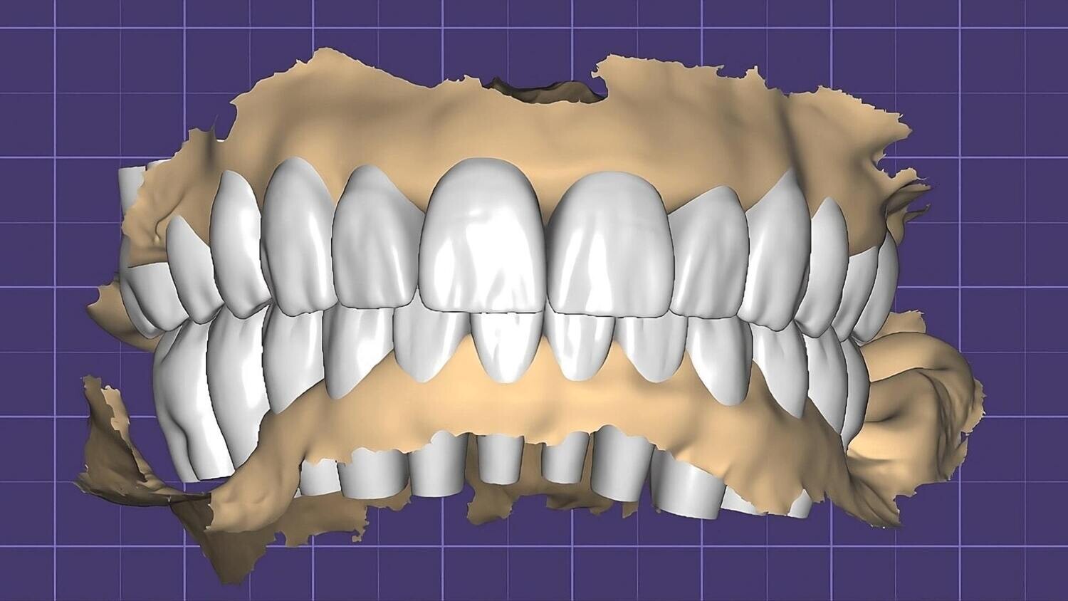 Digital Diagnostic Per Tooth Design