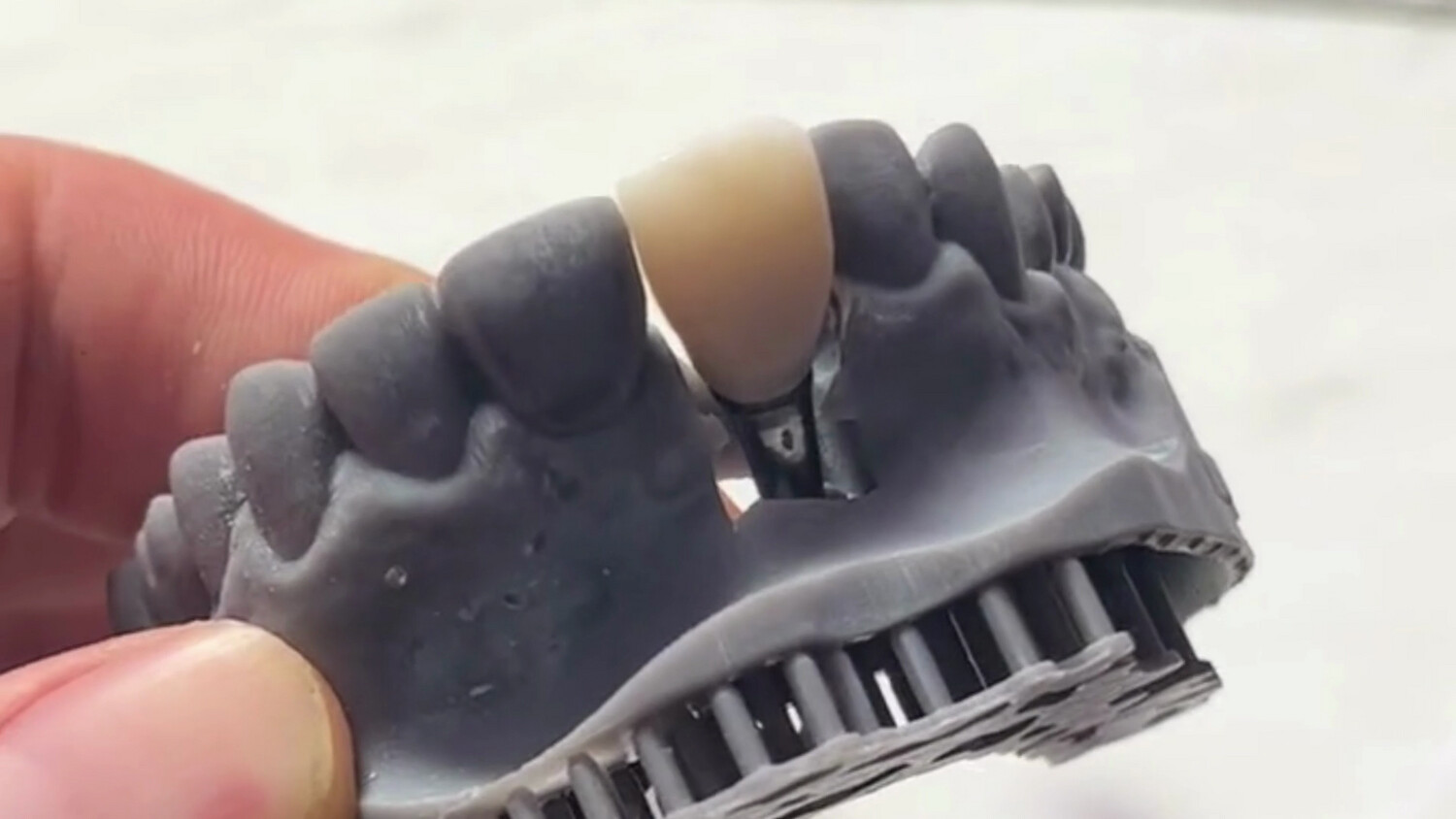 Zirconia Crown on Prep Tooth