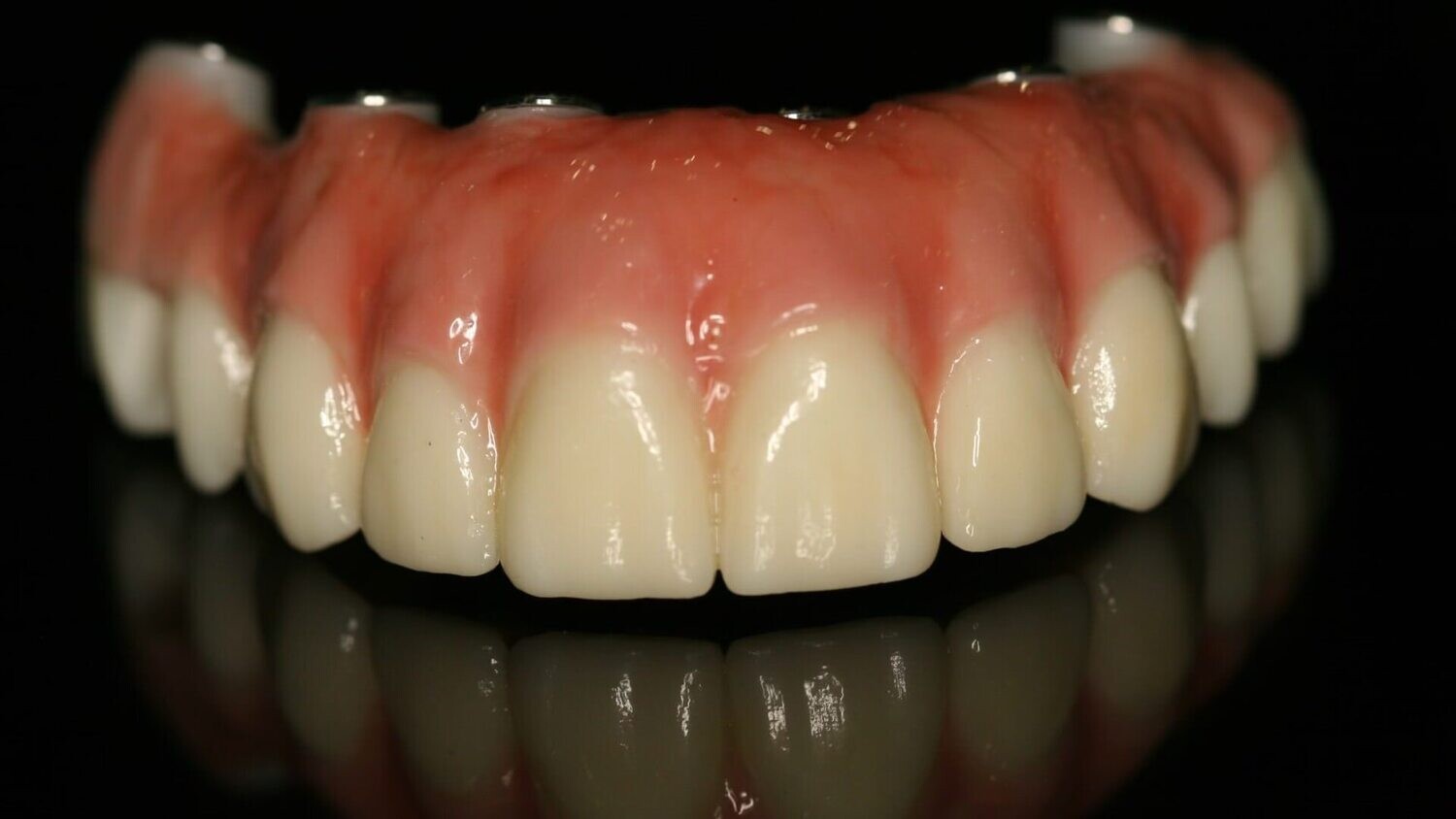 Full Arch Zirconia Bridge