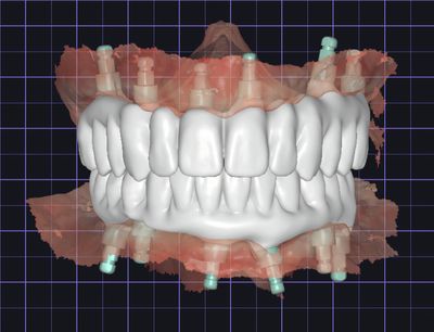 Full Arch Wax Up