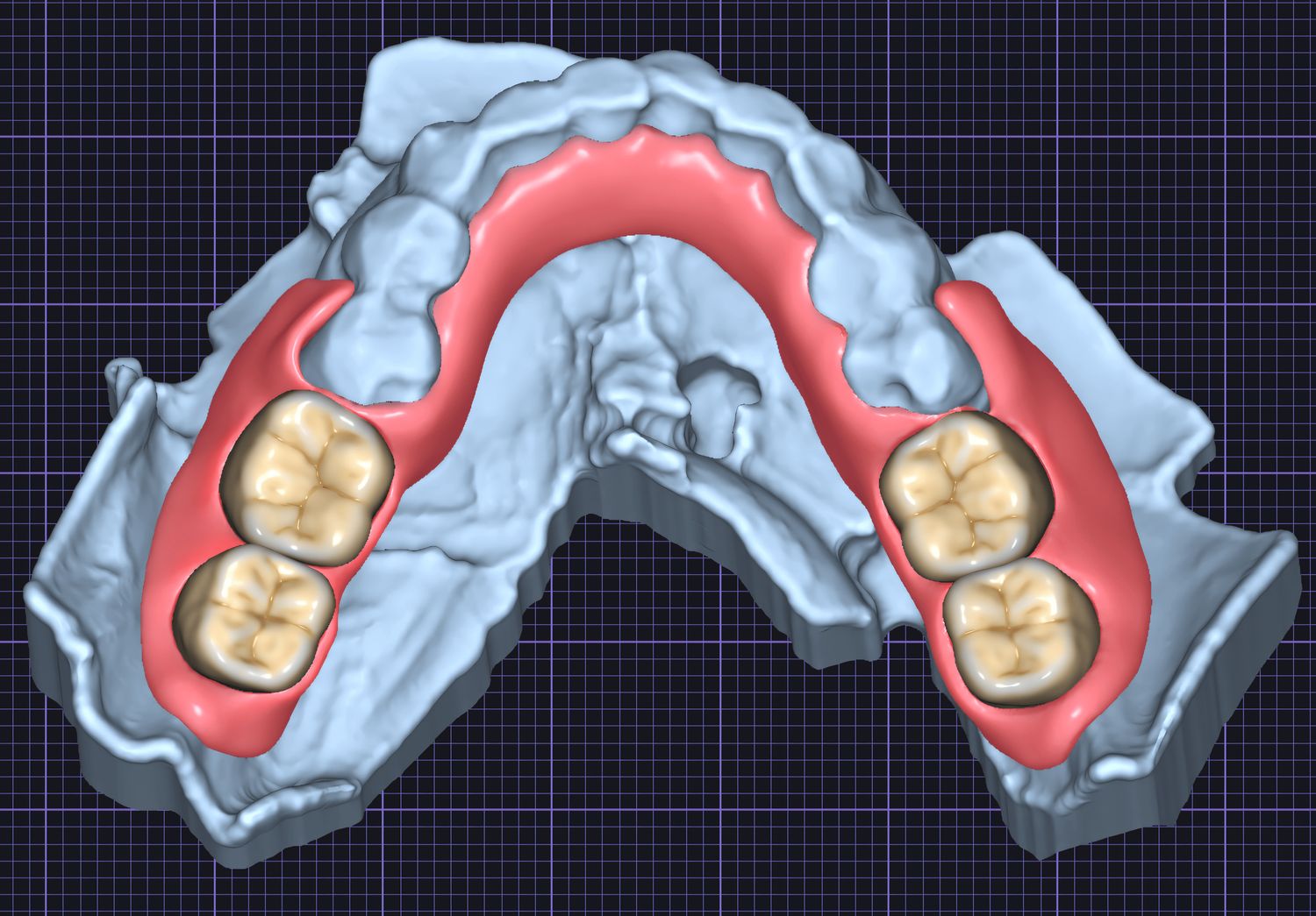 Partial Denture